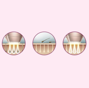 Philips Lumea Prestige IPL – Hair Removal Device+ Satin Compact Pen Trimmer (Model BRI94900)